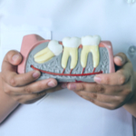 親知らずの抜歯