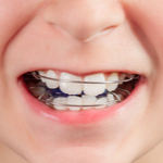 子どもにやさしい歯並び矯正「床矯正装置」